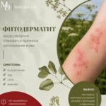 Растения и контактный дерматит: причины и первая помощь
